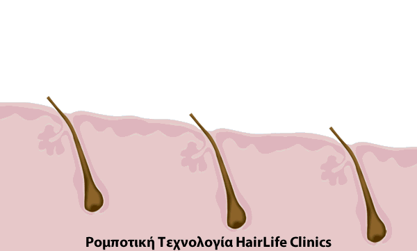 HairLife Clinics | Μεταμόσχευση Μαλλιών – Κύπρος | HairLife Clinics
